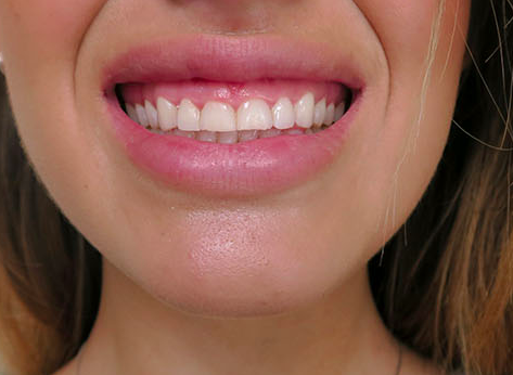 Aina har nyligen gjort en operation Aina har nyligen gjort en operation